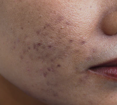 Active Acne and Hyperpigmentation