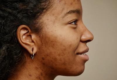 How to get rid of Hyperpigmentation