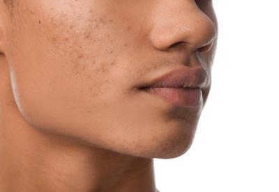 How to get rid of acne permanently in 6 Steps