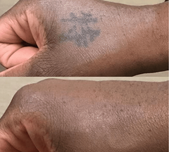 Tattoo and Pigment Removal