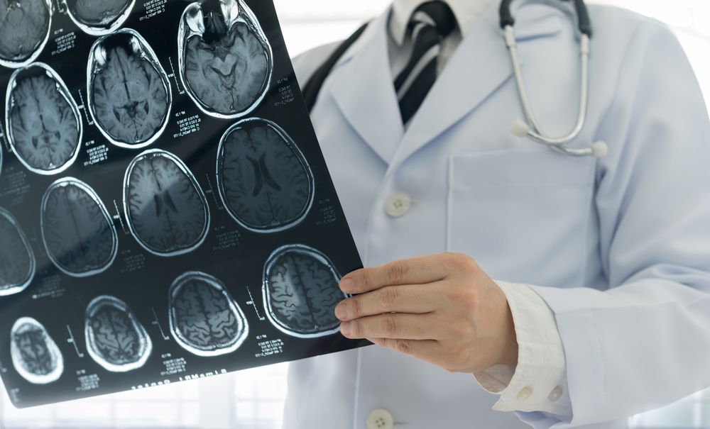 The Devastating Consequences Of Stroke Misdiagnosis | Domnick ...