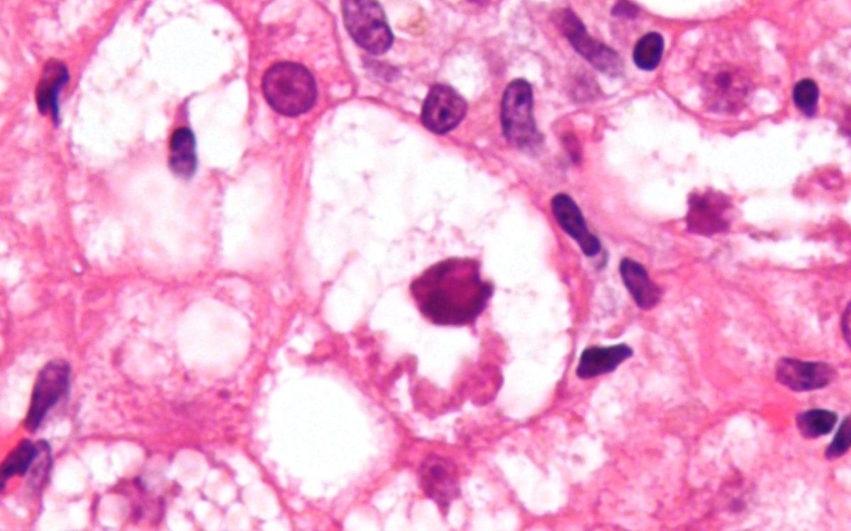 Liver biopsy with steatohepatitis under the microscope