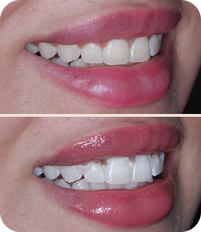 Before and after dental treatment at Smile Island Clinic