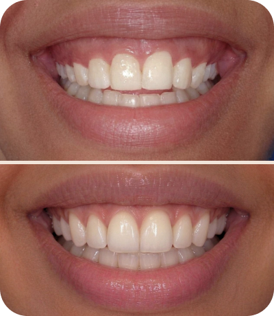 Before and after dental treatment at Smile Island Clinic