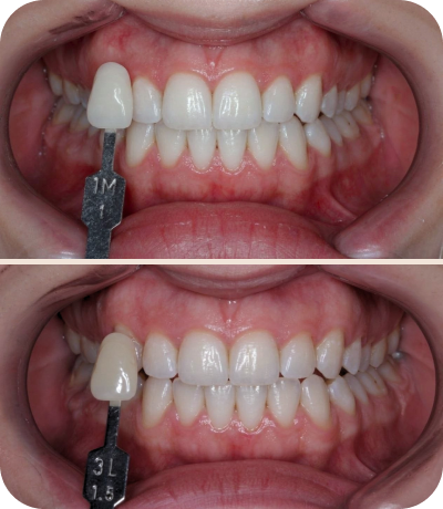 Before and after dental treatment at Smile Island Clinic