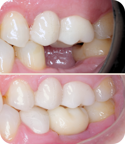 Before and after dental treatment at Smile Island Clinic