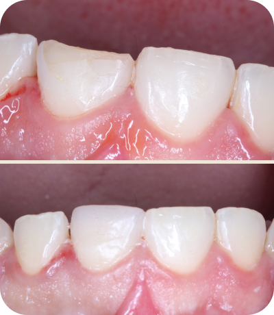 Before and after dental treatment at Smile Island Clinic