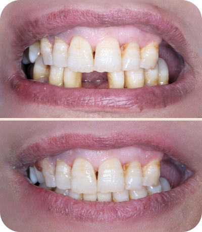Before and after dental treatment at Smile Island Clinic