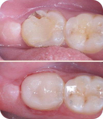 Before and after dental treatment at Smile Island Clinic