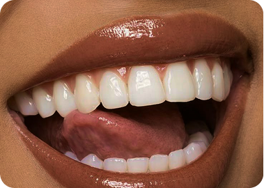 Veneers