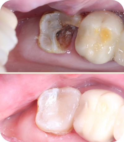 Before and after dental treatment at Smile Island Clinic