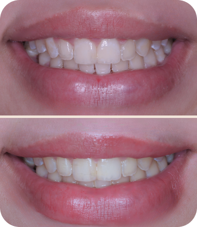 Before and after dental treatment at Smile Island Clinic