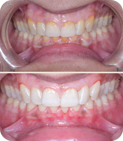 Before and after dental treatment at Smile Island Clinic