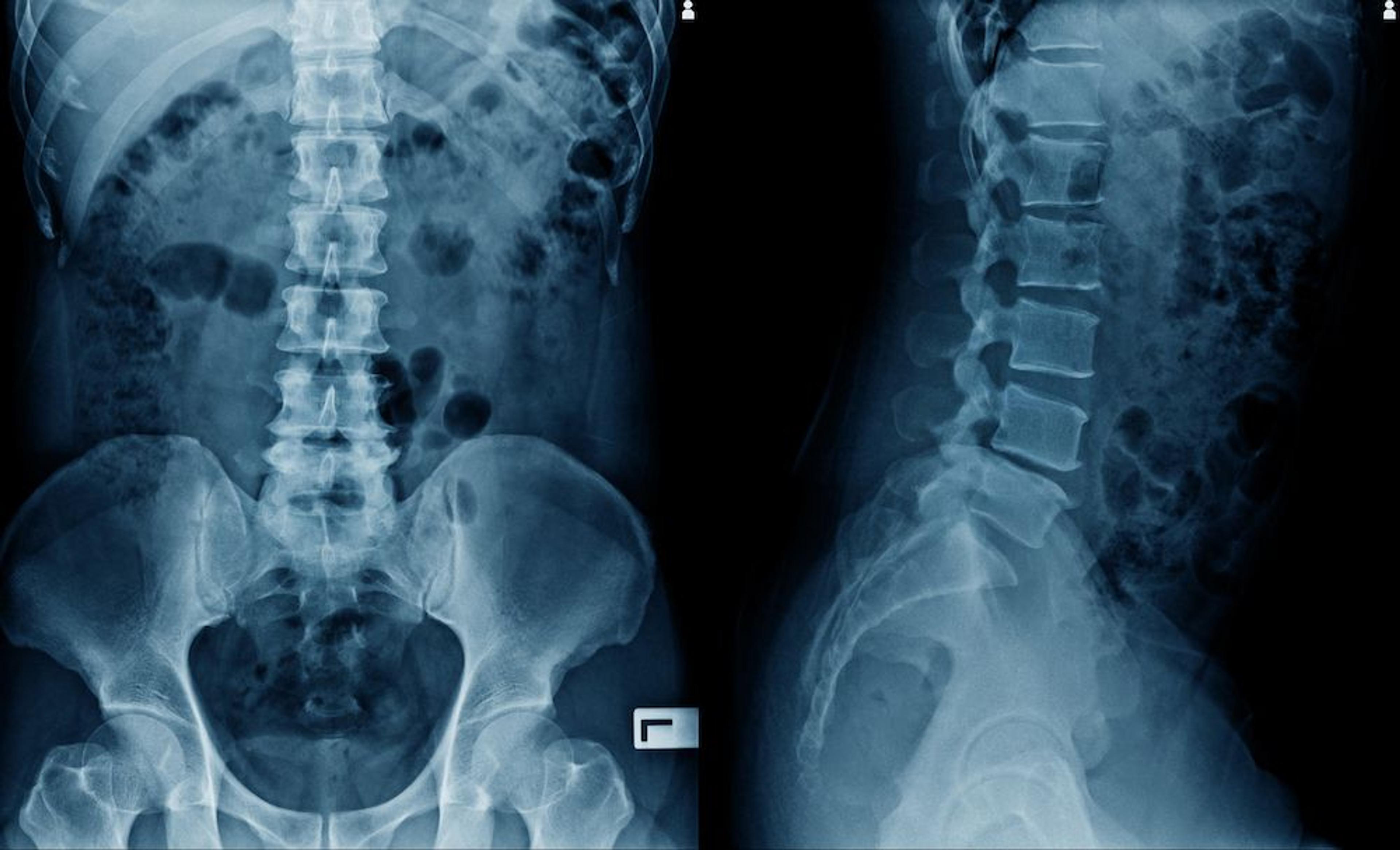 Digital spine x-ray for custom care plan at CornerStone Chiropractic in Minot, North Dakota