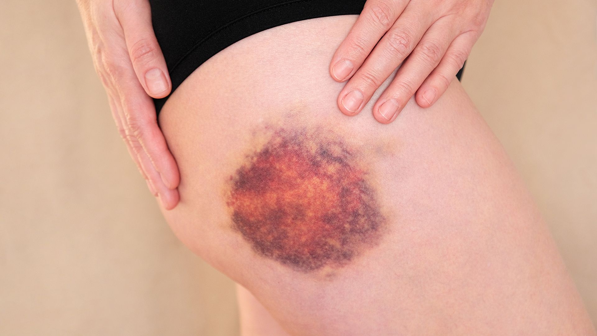 Prellung, blauer Fleck