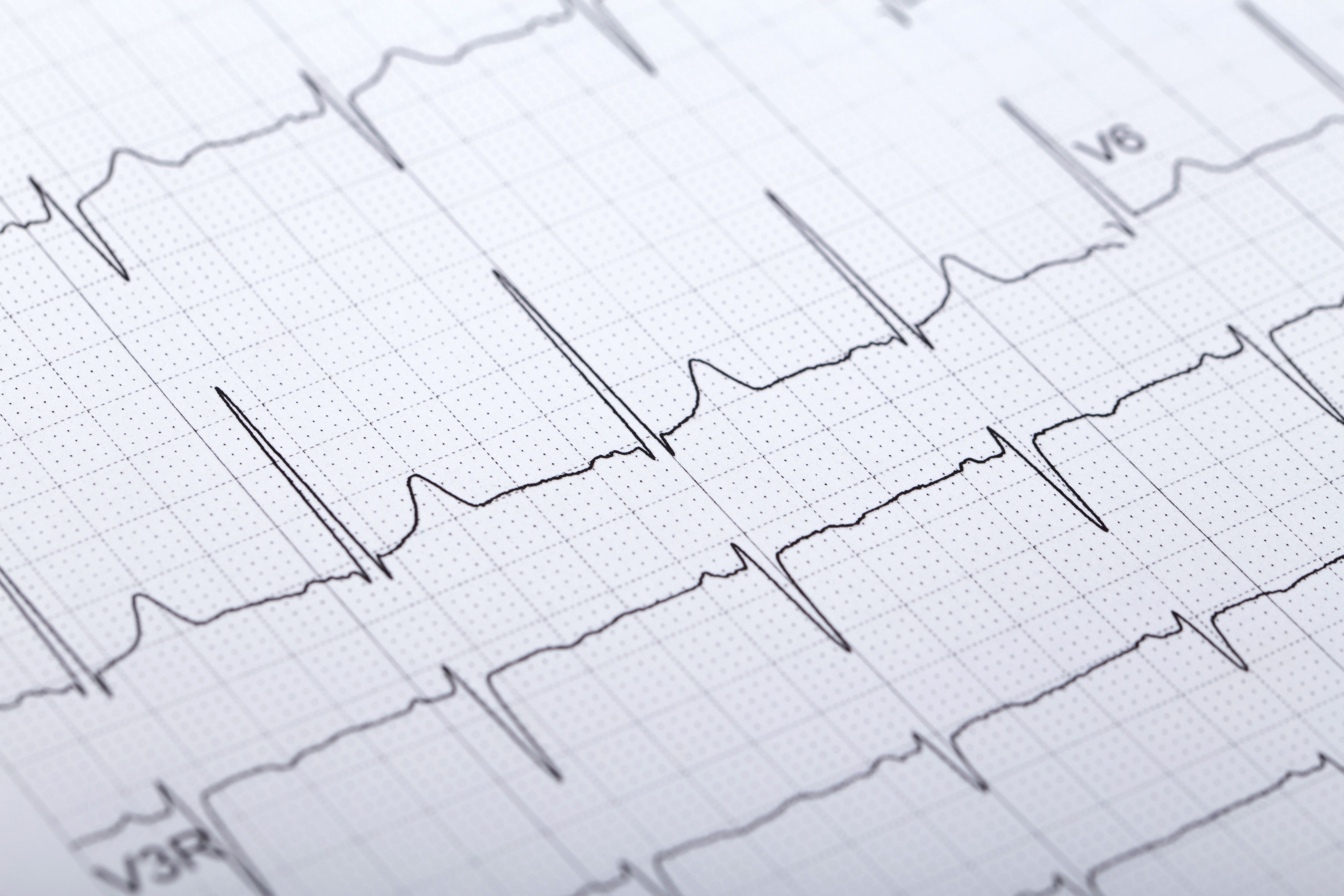 EKG