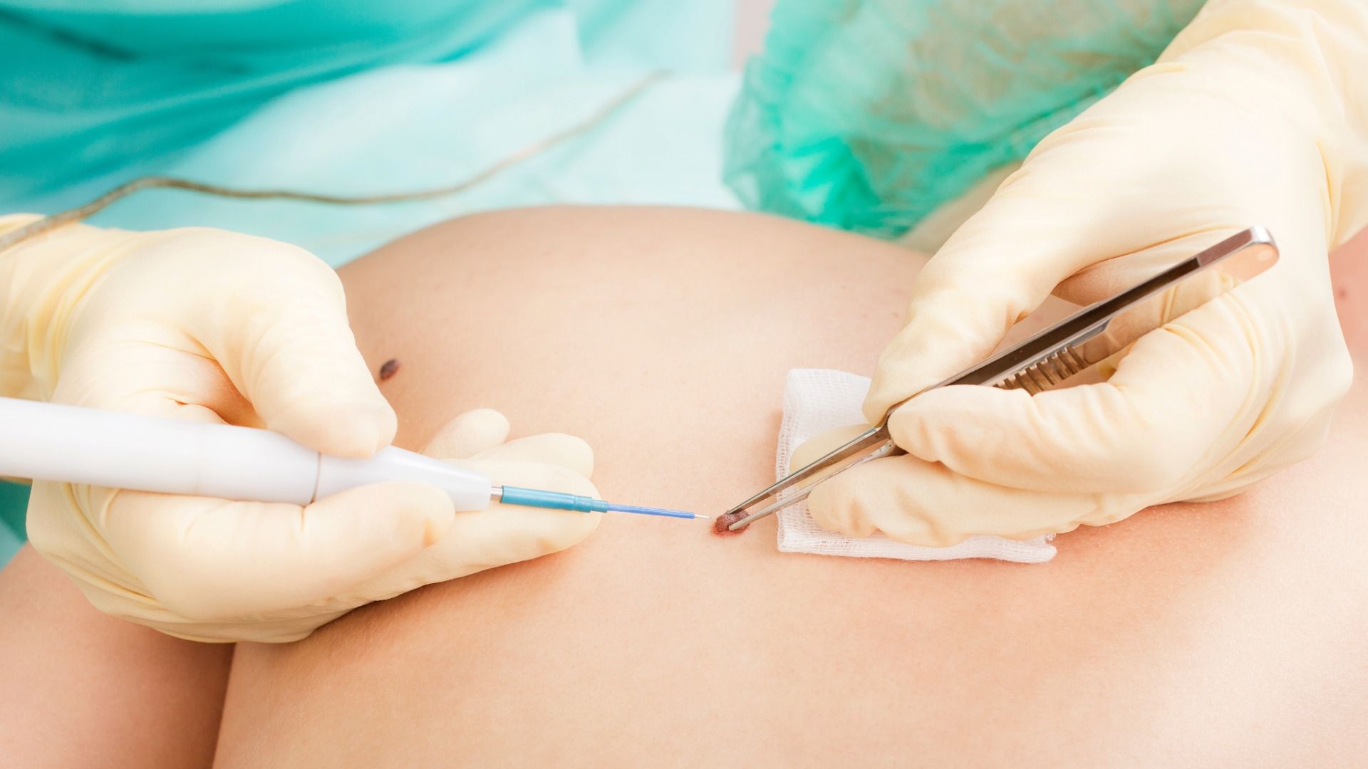 Dermatologie Operation