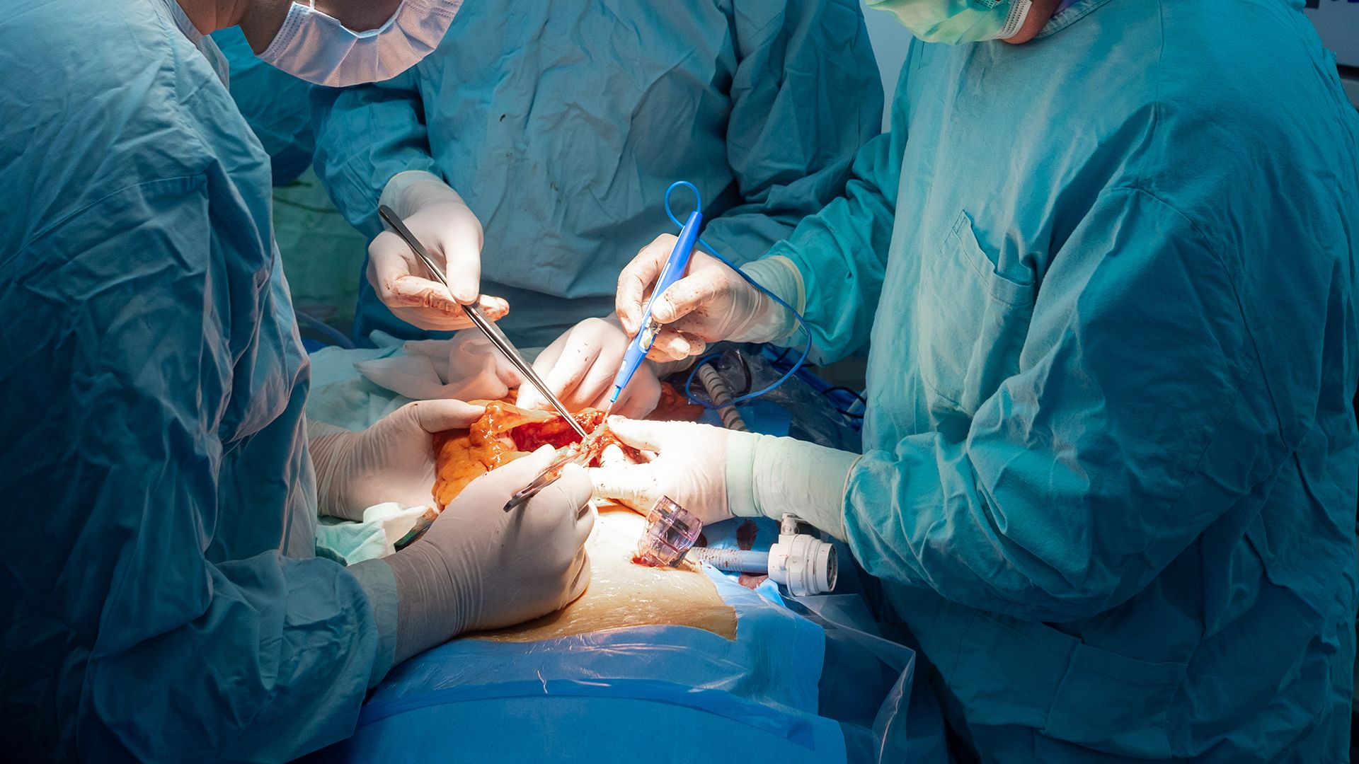 Chirurgen im OP-Saal bei Bauch-OP.
