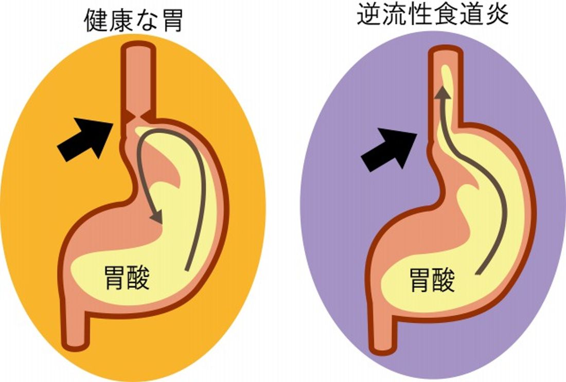 逆流性食道炎
