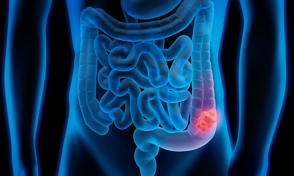 When Should You Start Getting Screened for Colorectal Cancer?