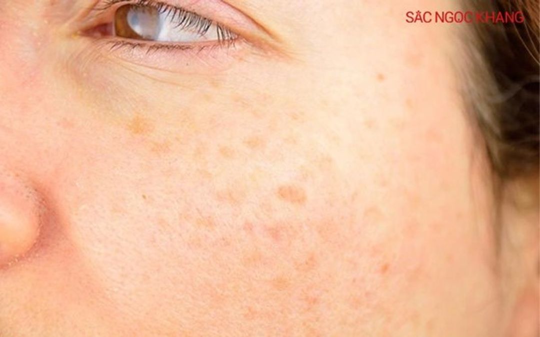 Cách chọn kem chống nắng phù hợp để bảo vệ da trong mùa hè này