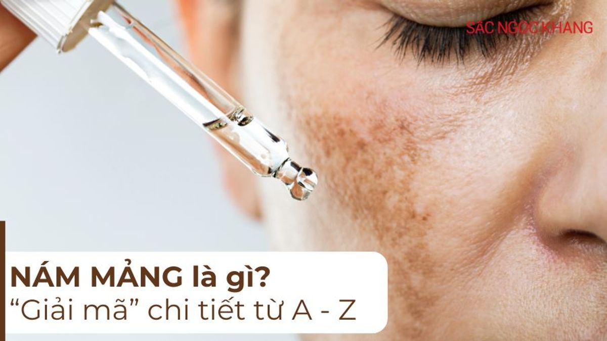 Nám mảng: “giải mã” từ A-Z về loại nám “khó chịu” này