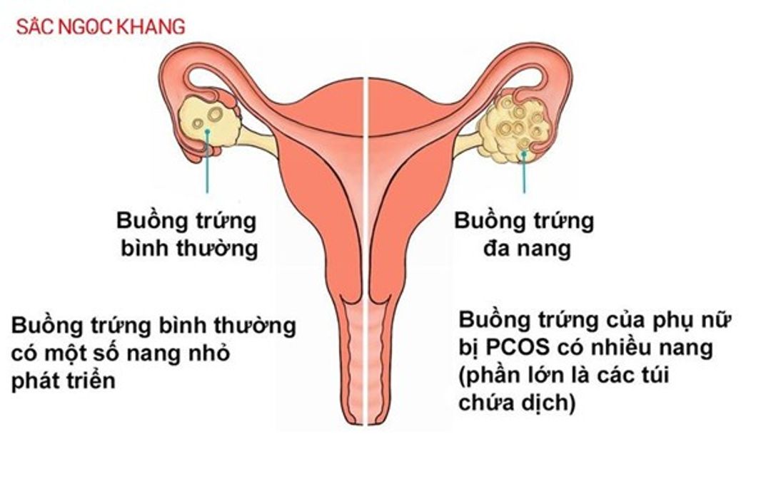 Rối loạn Estrogen: Dấu hiệu, nguyên nhân và cách phòng ngừa