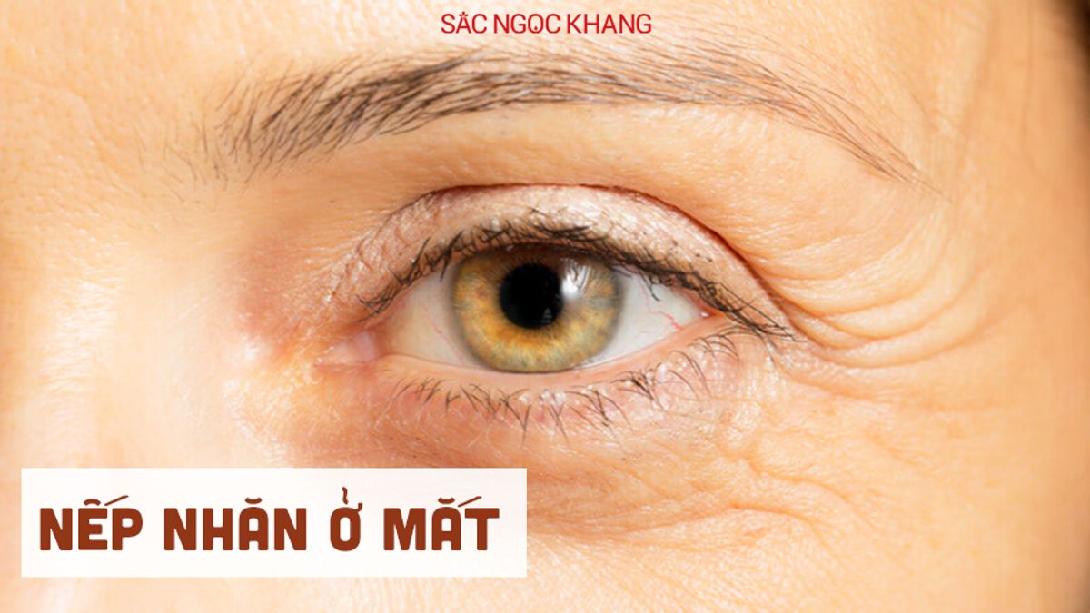 Nếp nhăn ở mắt: Nguyên nhân là do đâu?
