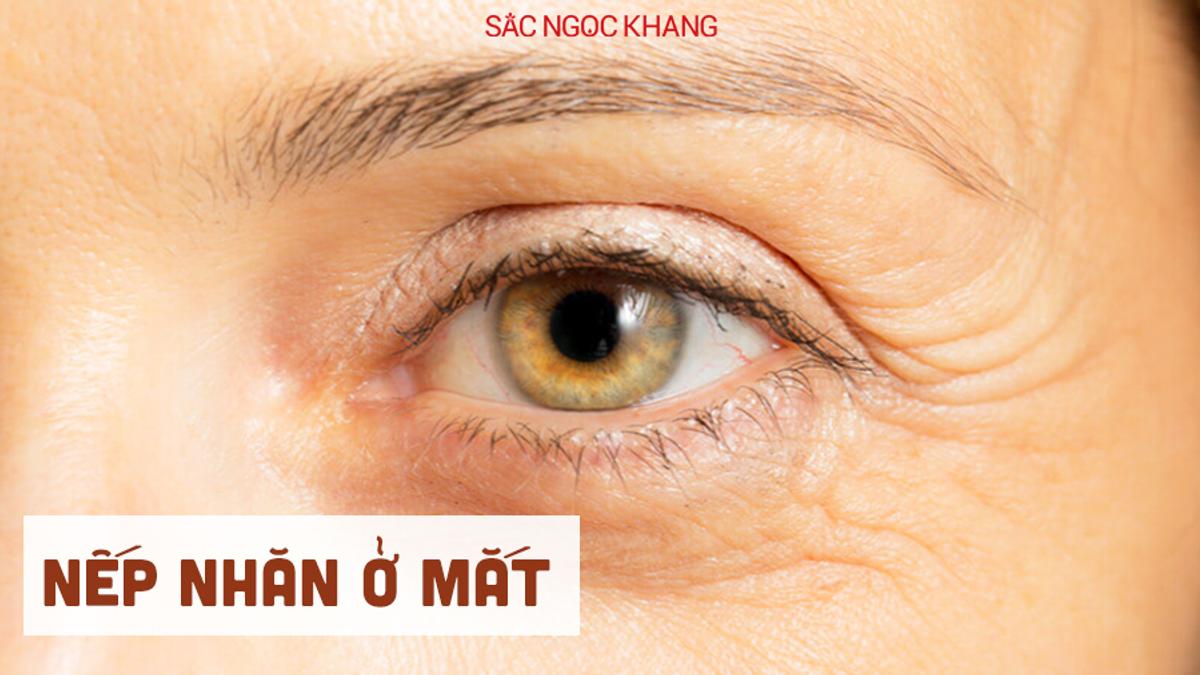 Wrinkles around the eyes: What are the causes?