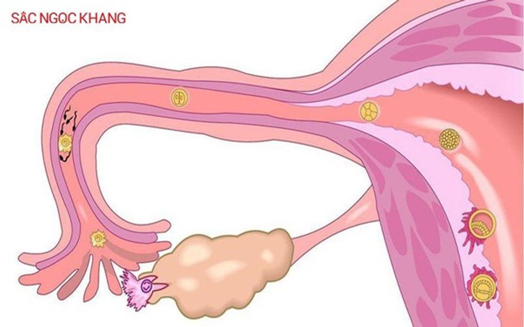 Rối loạn Estrogen: Dấu hiệu, nguyên nhân và cách phòng ngừa