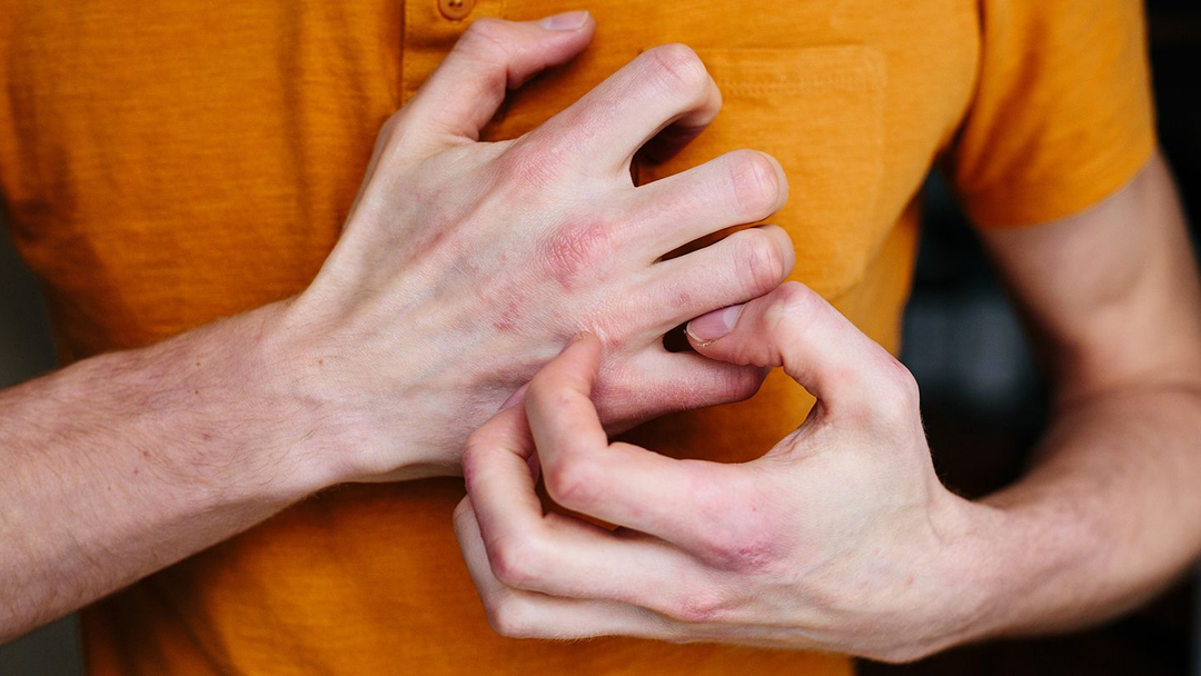 BỆNH VIÊM DA CƠ ĐỊA