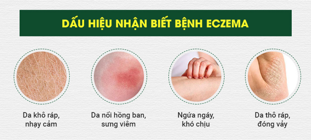 BỆNH VIÊM DA CƠ ĐỊA