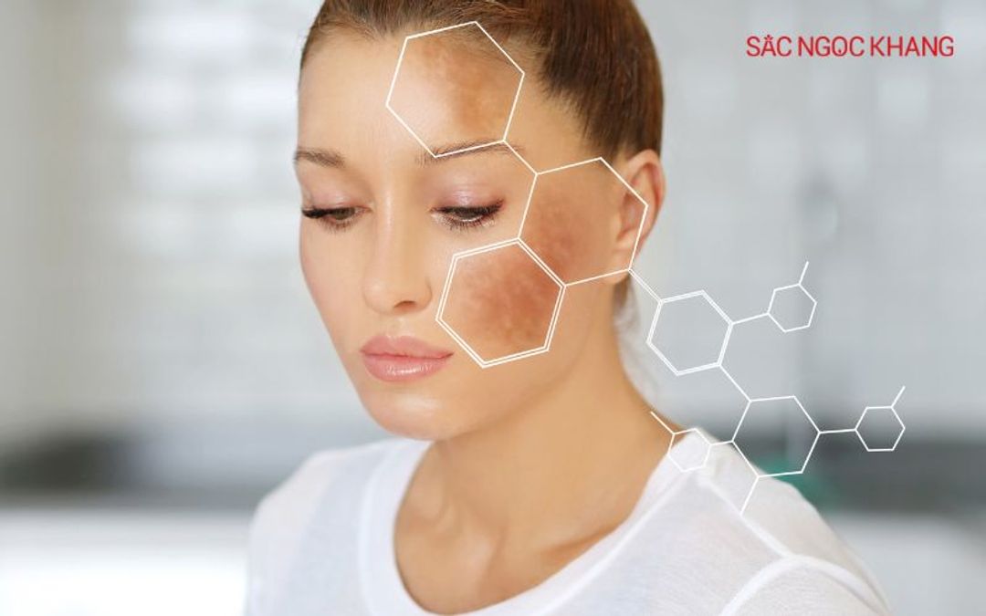 Nám mảng thường tập trung chủ yếu ở hai bên gò má