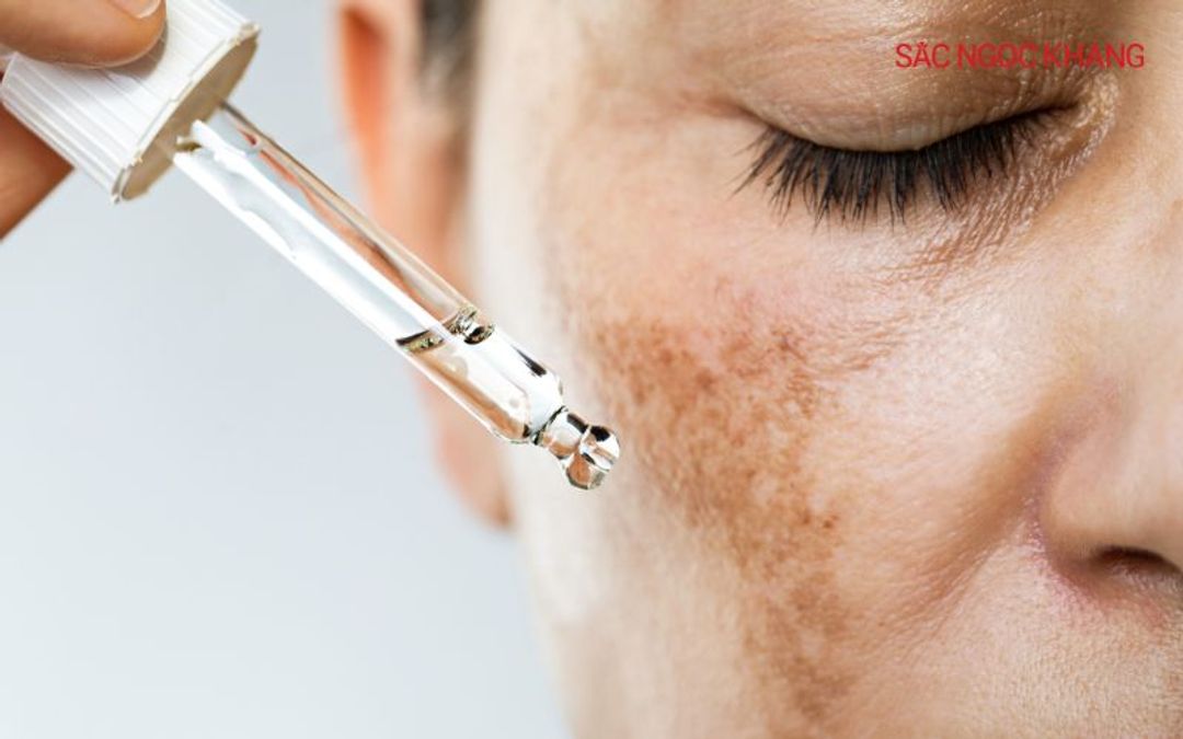 Sử dụng các sản phẩm hỗ trợ trị nám