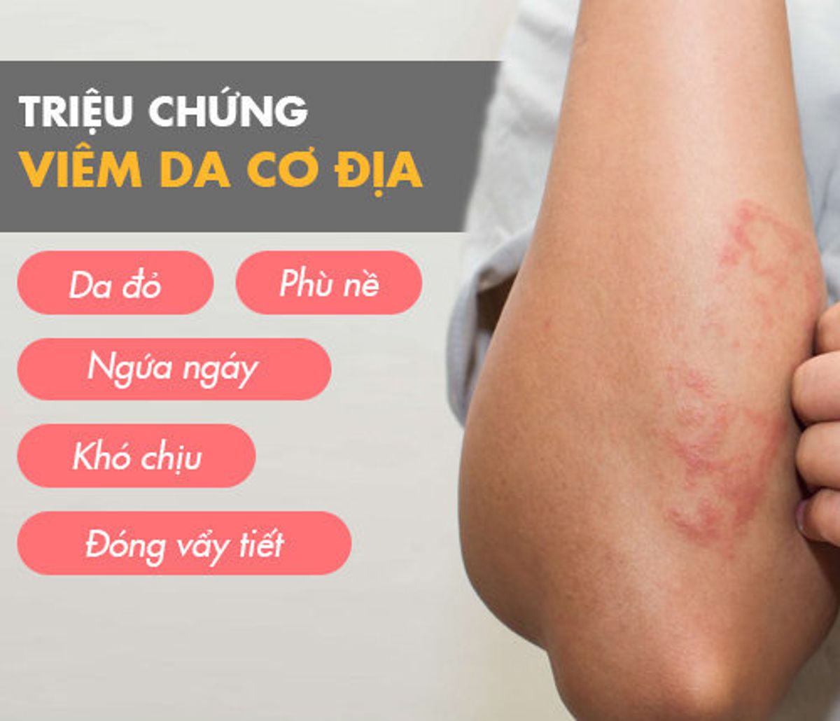 Bệnh viêm da cơ địa