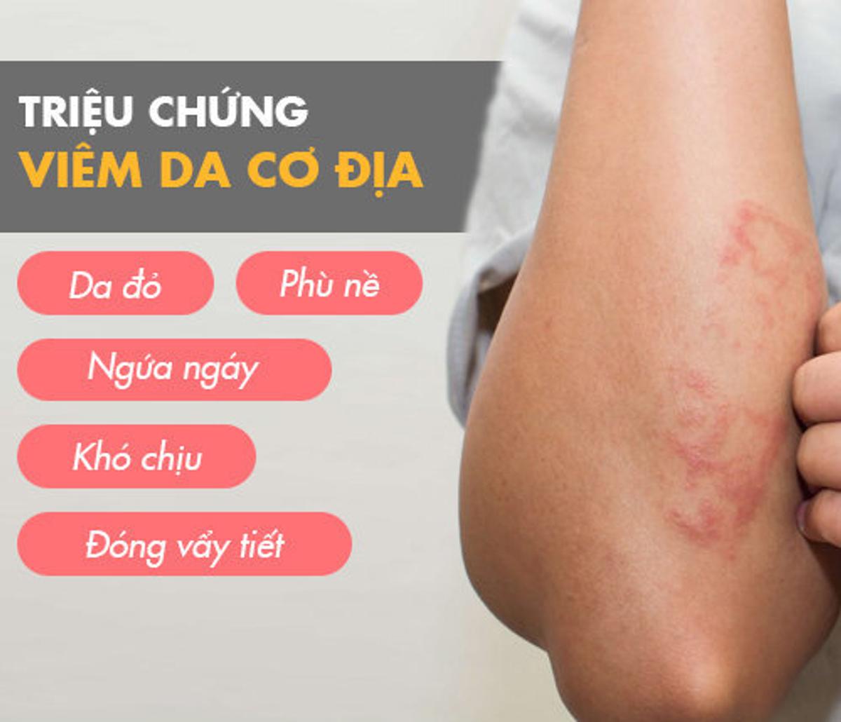 Atopic dermatitis