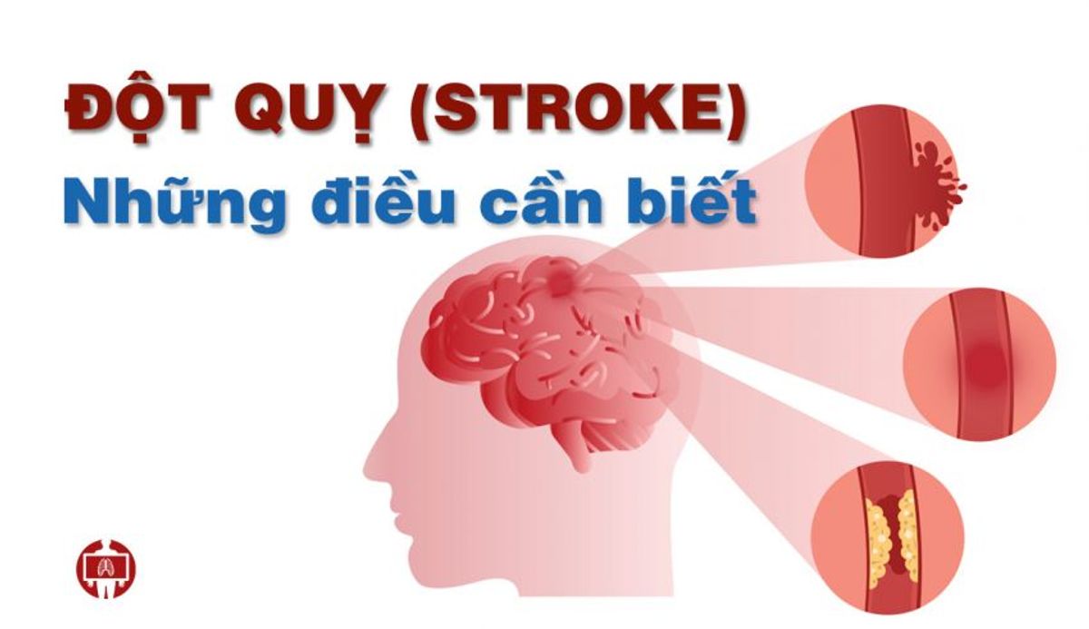 Đột quỵ và những thông tin cần biết
