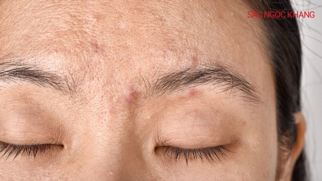 Sợi bã nhờn là gì? Giải pháp toàn diện cho làn da mịn màng