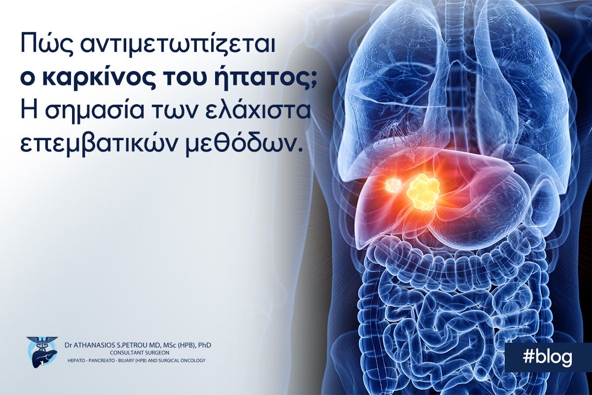 Πώς αντιμετωπίζεται ο καρκίνος του ήπατος; Η σημασία των ελάχιστα επεμβατικών μεθόδων.