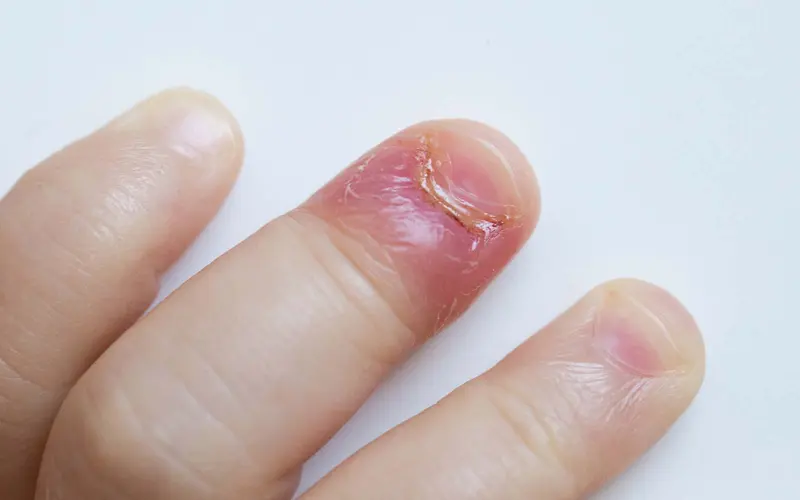 Barnefinger med neglerotbetennelse