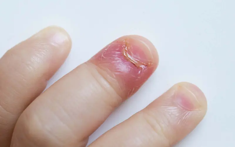 Barnefinger med neglerotbetennelse