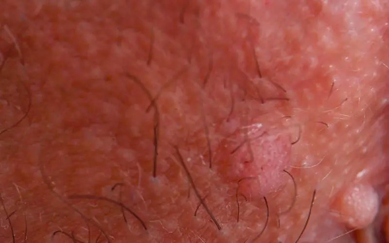 Nærbilde av kjønnsvorter (kondylomer)