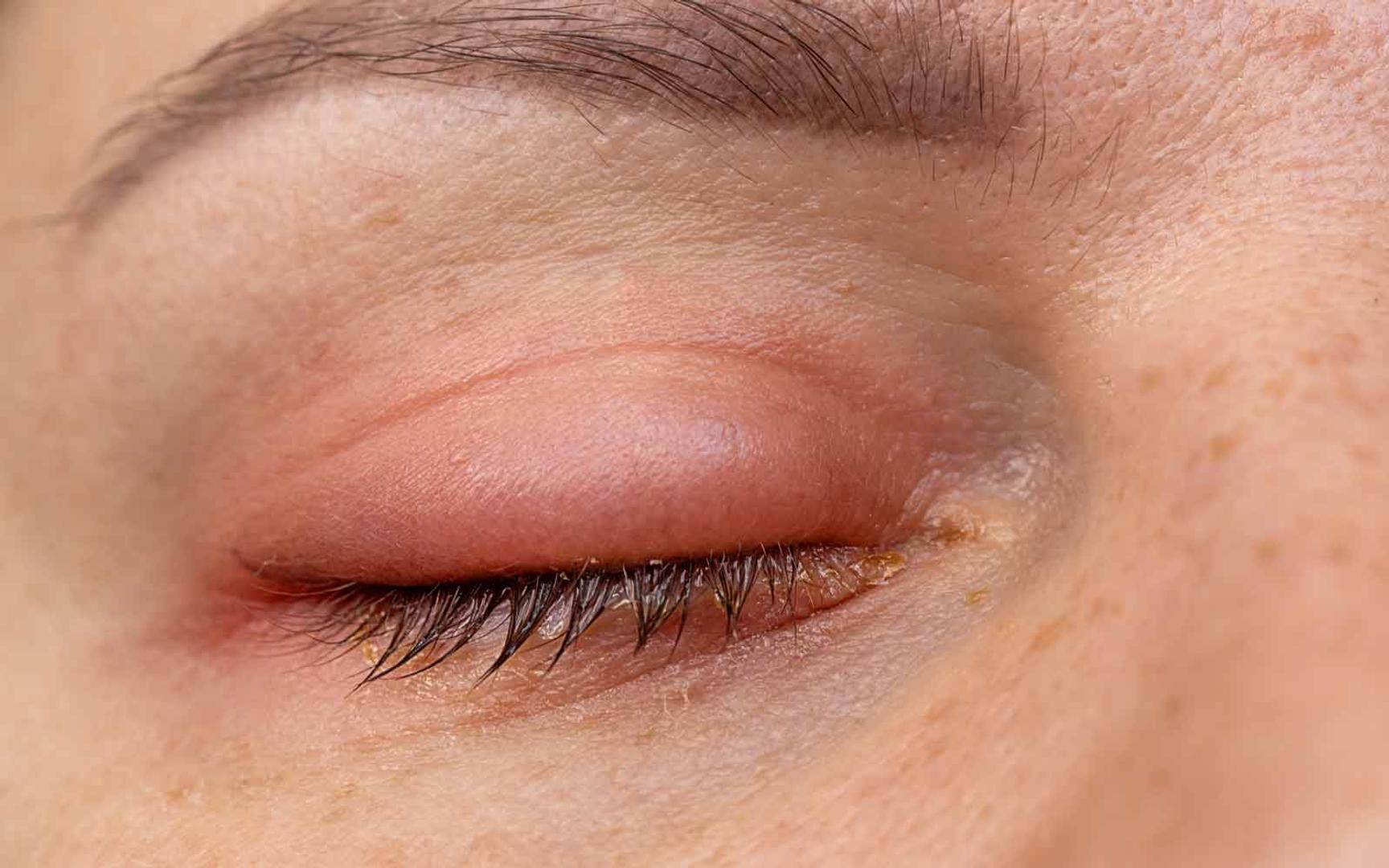 Rødt og hovent øyelokk med puss nederst på øyevippene, typisk ved blefaritt