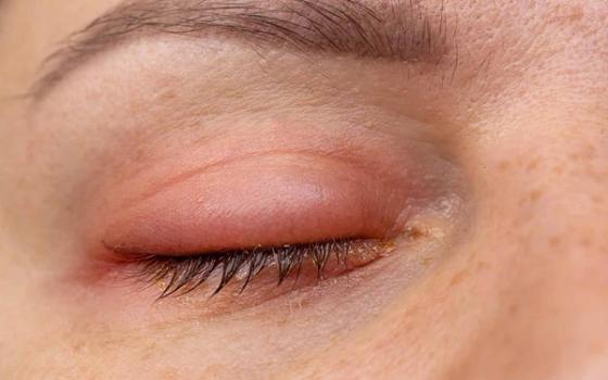 Hva er blefaritt? Hva er blefaritt?