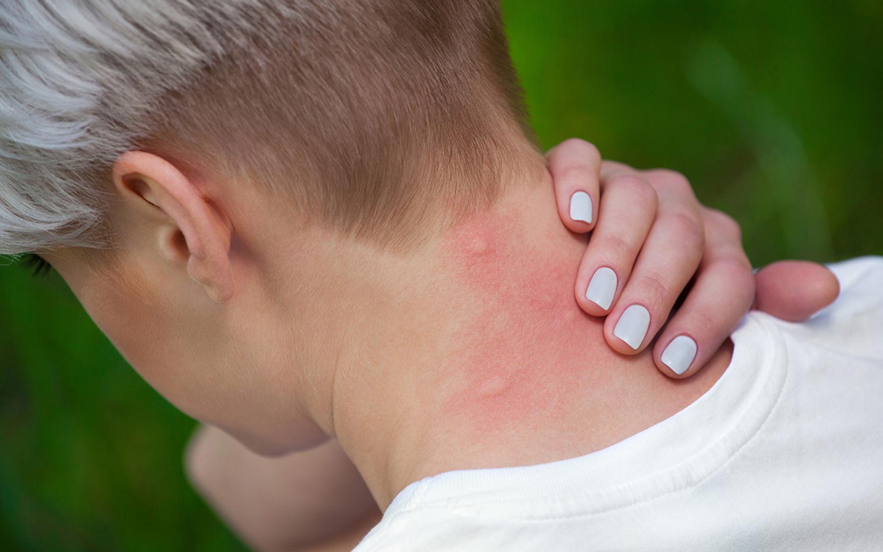 En person med kort hår klør seg i nakken, der huden er rød og irritert, på grunn av et insektbitt.