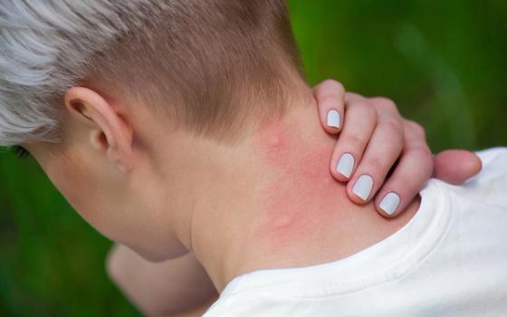 Hjemmeapoteket - hjelp mot stikk, bitt og sommerplager Hjemmeapoteket - hjelp mot stikk, bitt og sommerplager