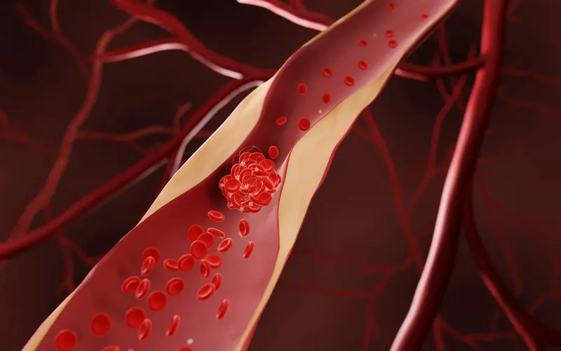 Illustrasjon av blodproppdannelse i blodåre