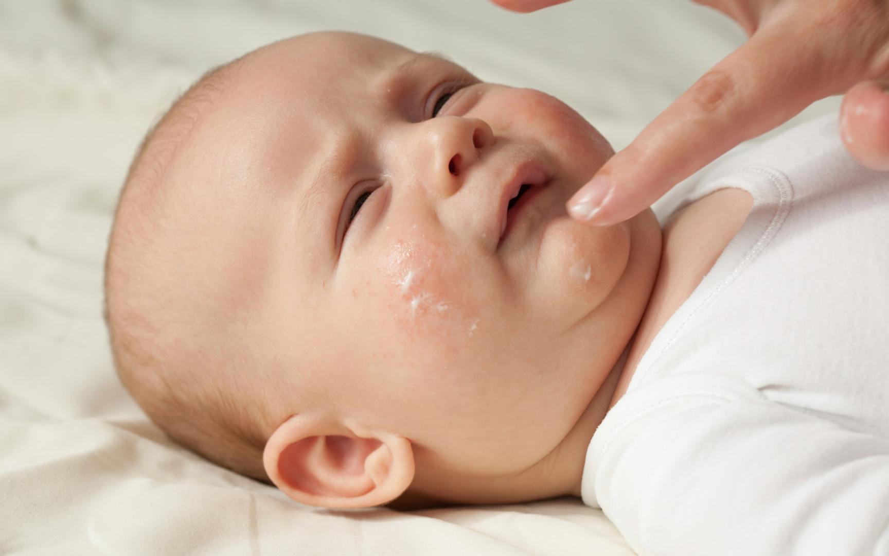 Bilde av en baby som får smurt salve på kinn og hake.