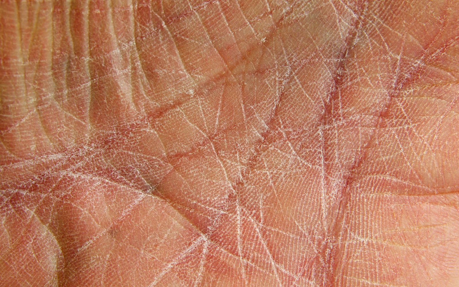 Tørr, sprukken hud med tydelig grov overflate og hvite tørrhetslinjer.