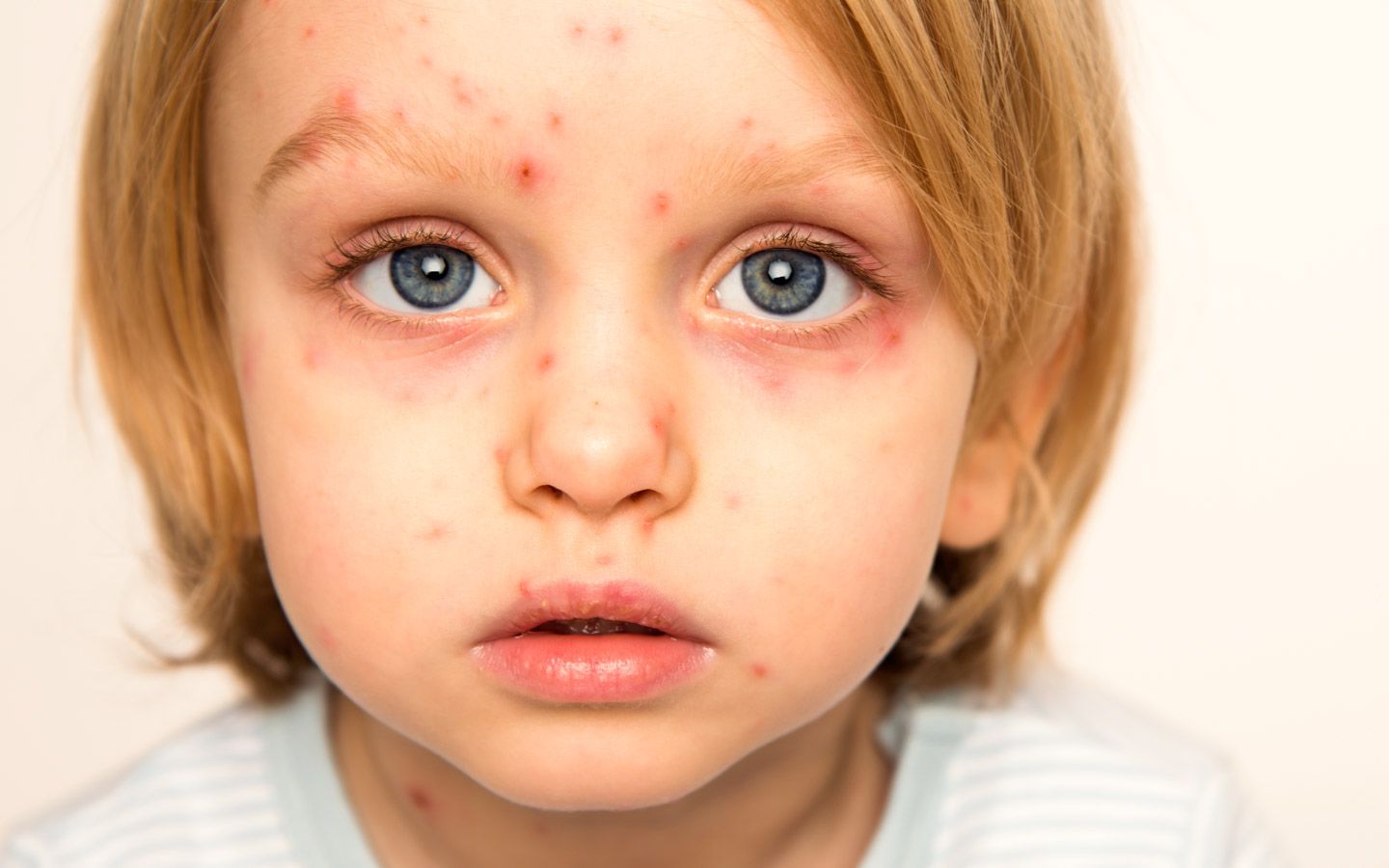Nærbilde av et barn med røde prikker og utslett i ansiktet. 